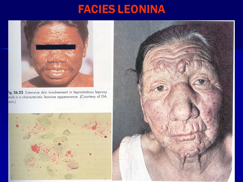 FACIES LEONINA